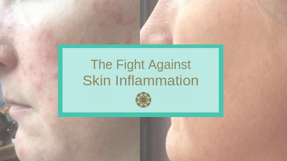 The Fight Against Skin Inflammation